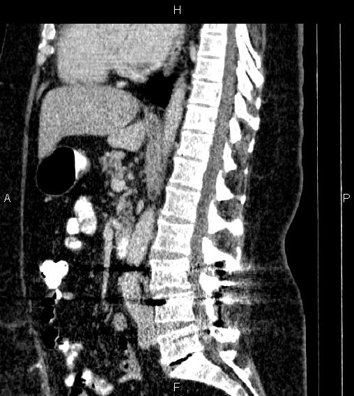 File:Adrenal myelolipoma (Radiopaedia 84319-99617 Sagittal renal cortical phase 48).jpg