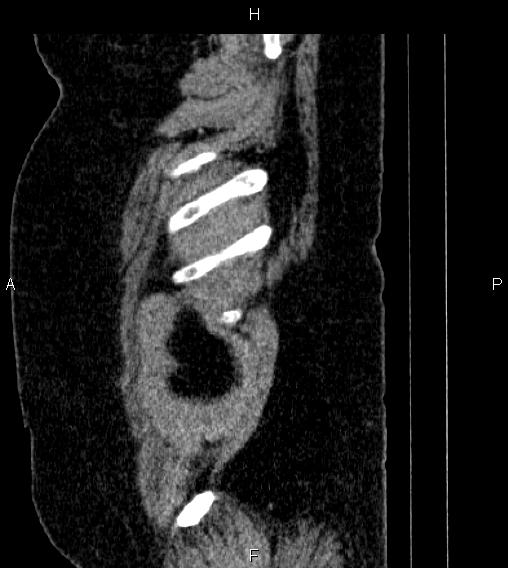 Adrenal myelolipoma (Radiopaedia 84319-99617 Sagittal renal cortical phase 94).jpg