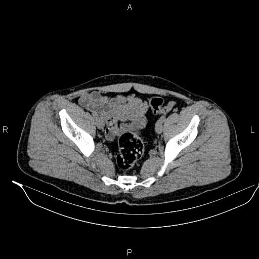 Adrenal myelolipoma (Radiopaedia 87794-104246 Axial non-contrast 90).jpg