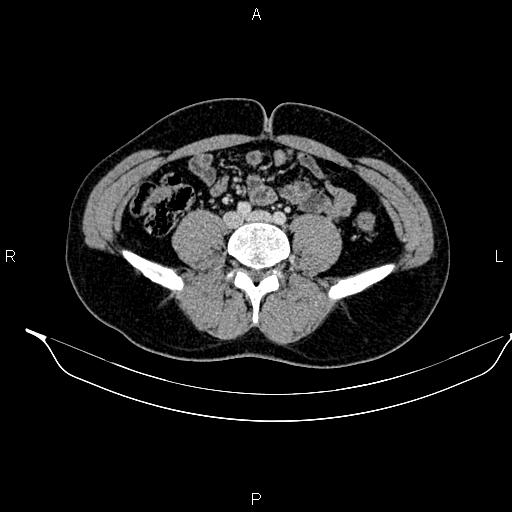 Adrenal myelolipoma (Radiopaedia 87794-104246 Axial renal cortical phase 68).jpg