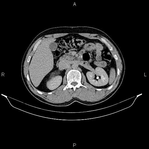 Adrenal myelolipoma (Radiopaedia 87794-104246 Axial renal excretory phase 36).jpg