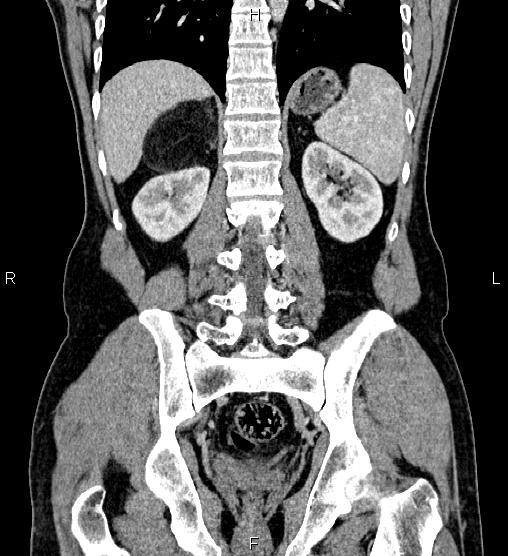 File:Adrenal myelolipoma (Radiopaedia 87794-104246 Coronal renal cortical phase 46).jpg