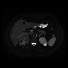File:Adrenal myelolipoma - MRI (Radiopaedia 83249-97646 Axial STIR 15).jpg