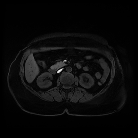 Adrenal myelolipoma - MRI (Radiopaedia 83249-97646 Axial T1 fat sat 46).jpg
