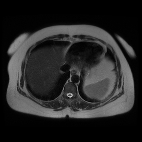 File:Adrenal myelolipoma - MRI (Radiopaedia 83249-97646 Axial T2 5).jpg