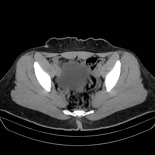 Adrenal myelolipoma - bilateral (Radiopaedia 74805-85810 Axial non-contrast 72).jpg