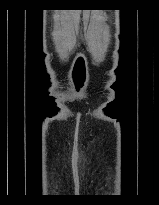 Adrenal myelolipoma - bilateral (Radiopaedia 74805-85810 Coronal C+ portal venous phase 33).jpg