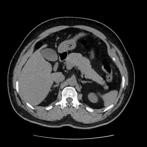 Adrenal myelolipoma and beaver tail liver (Radiopaedia 86201-102193 Axial non-contrast 147).jpg
