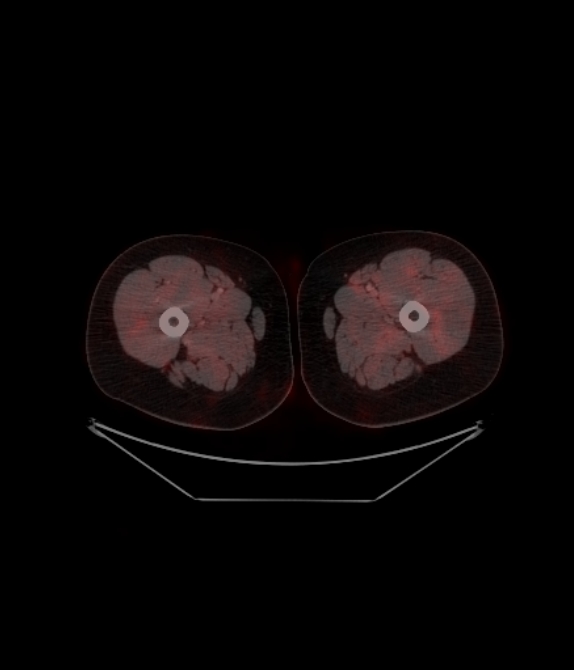 Adrenocortical carcinoma (Radiopaedia 80134-93440 ِAxial 298).jpg