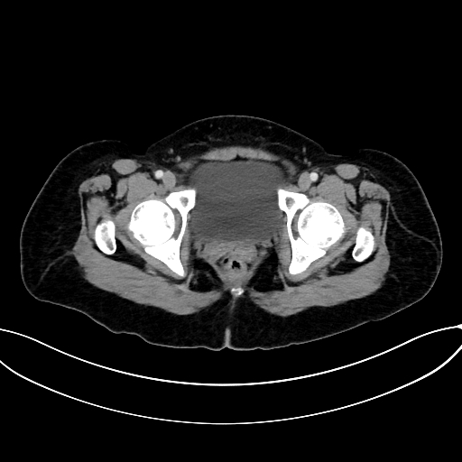 Adrenocortical carcinoma (Radiopaedia 87281-103569 Axial C+ portal venous phase 84).jpg