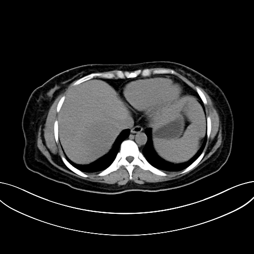 Adrenocortical carcinoma (Radiopaedia 87281-103569 Axial non-contrast 13).jpg
