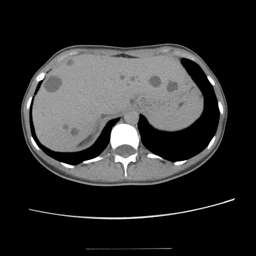 Adult polycystic kidney disease (Radiopaedia 48845-53876 Axial renal excretory phase 23).jpg