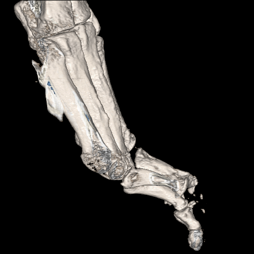 File:Advanced osteomyelitis due to open metatarsal fracture (Radiopaedia 83891-99095 VRT 22).jpg
