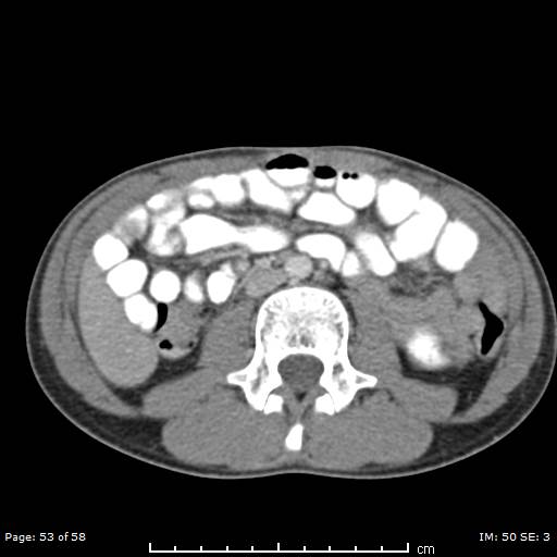 Agenesis of the gallbladder (Radiopaedia 55454-61905 B 53).jpg