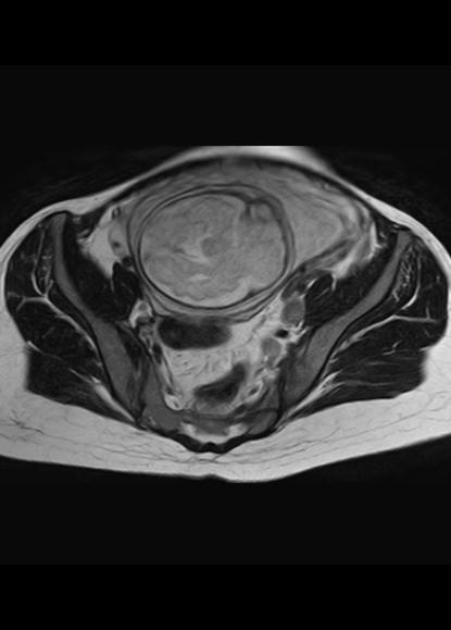 File:Aggressive angiomyxoma of the pelvis and perineum (Radiopaedia 59162-66479 Axial T2 18).jpg