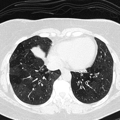 Air trapping in small airway disease (Radiopaedia 61685-69694 Axial lung window 127).jpg