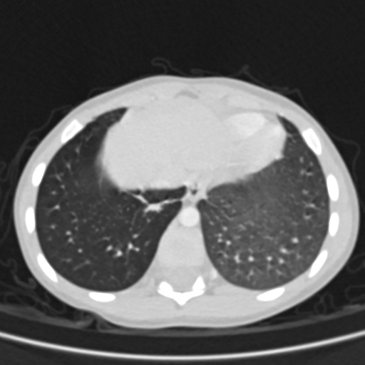 Airway foreign body (Radiopaedia 72128-82638 Axial lung window 75).jpg