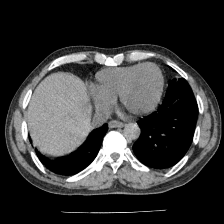 Airway foreign body in adult (Radiopaedia 85907-101779 Axial liver window 141).jpg