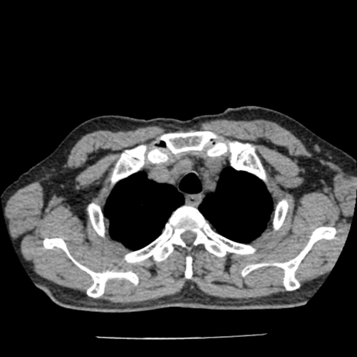 Airway foreign body in adult (Radiopaedia 85907-101779 Axial liver window 6).jpg