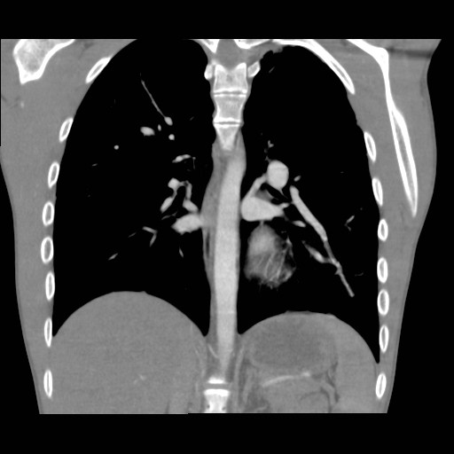 File:Alagille syndrome with pulmonary hypertension (Radiopaedia 49384-54980 C 6).jpg