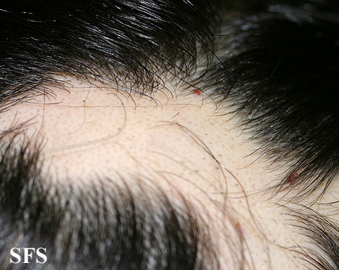 Alopecia Areata (Dermatology Atlas 19).jpg