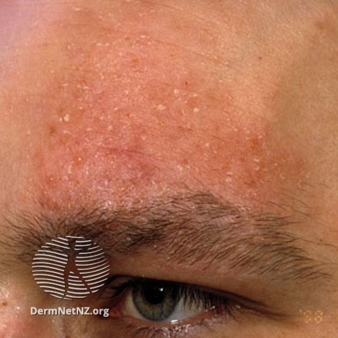 File:Alopecia mucinosa (DermNet NZ hair-nails-sweat-s-alop-mucin6).jpg