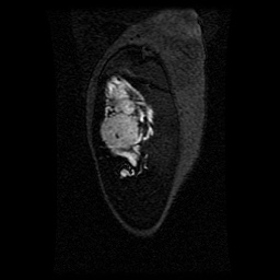 Alveolar soft part sarcoma (Radiopaedia 64501-73678 D 120).jpg
