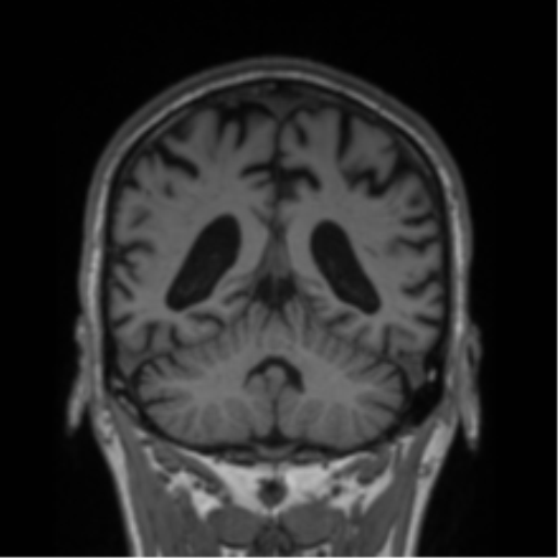 Alzheimer's disease- with Gerstmann syndrome and dressing apraxia (Radiopaedia 54882-61150 Coronal T1 30).png