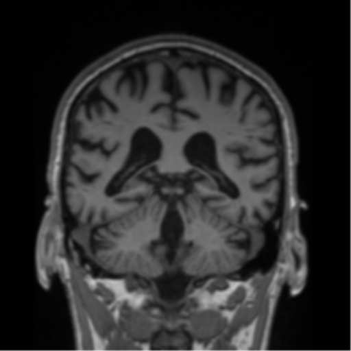 Alzheimer's disease- with Gerstmann syndrome and dressing apraxia (Radiopaedia 54882-61150 Coronal T1 34).png