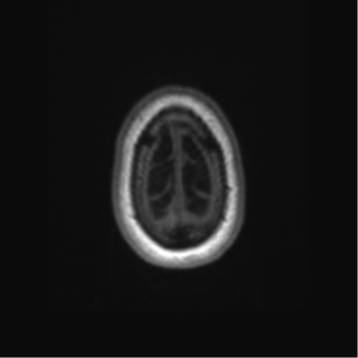 Alzheimer's disease (Radiopaedia 42658-45802 Axial T1 16).png