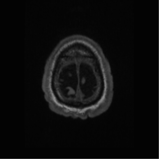 File:Alzheimer disease - probable (Radiopaedia 35334-36837 Axial T1 69).png