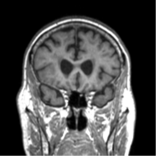 File:Alzheimer disease and cerebral amyloid angiopathy (Radiopaedia 64234-73011 Coronal T1 49).png