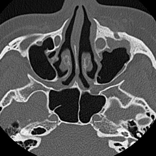 File:Ameloblastic fibro-odontoma (Radiopaedia 18843-18780 C 9).jpg