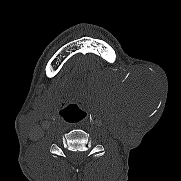 Ameloblastoma (Radiopaedia 51921-57766 Axial bone window 34).jpg