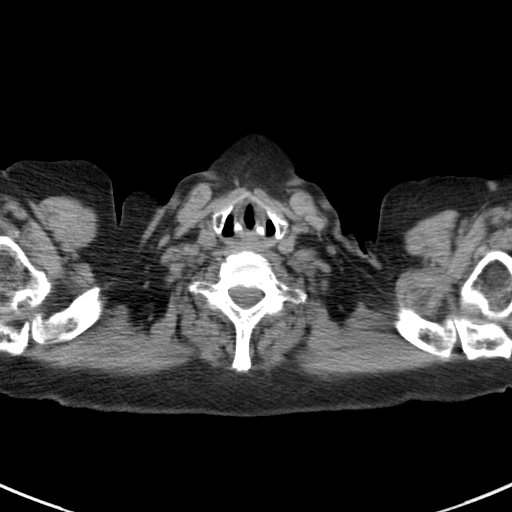 File:Amiodarone-induced pulmonary fibrosis (Radiopaedia 82355-96460 Axial non-contrast 2).jpg