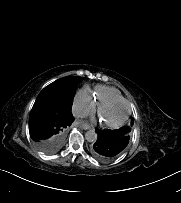 Amiodarone deposition in the liver (Radiopaedia 77587-89780 Axial non-contrast 59).jpg