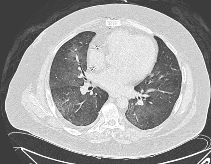 Amiodarone lung (Radiopaedia 62514-70769 Axial lung window 50).jpg