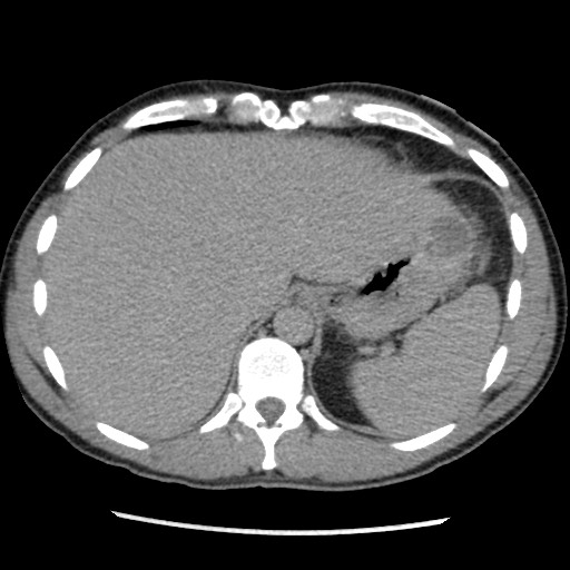 Amoebic liver abscesses (Radiopaedia 55536-62009 Axial C+ delayed 17).jpg