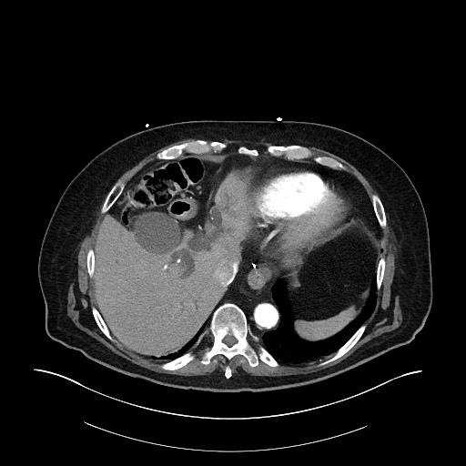 Ampullary adenocarcinoma (Radiopaedia 59373-66734 A 36).jpg