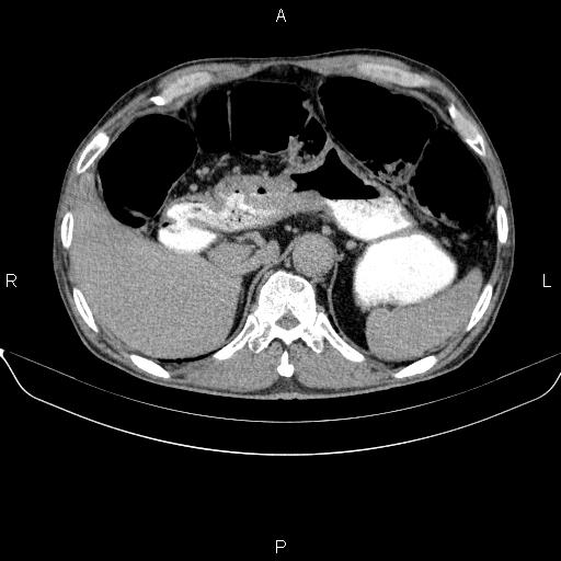 Ampullary adenocarcinoma (Radiopaedia 86093-102032 Axial C+ delayed 24).jpg