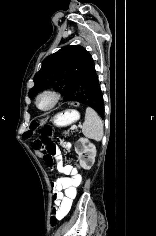 Ampullary adenocarcinoma (Radiopaedia 86093-102033 E 74).jpg