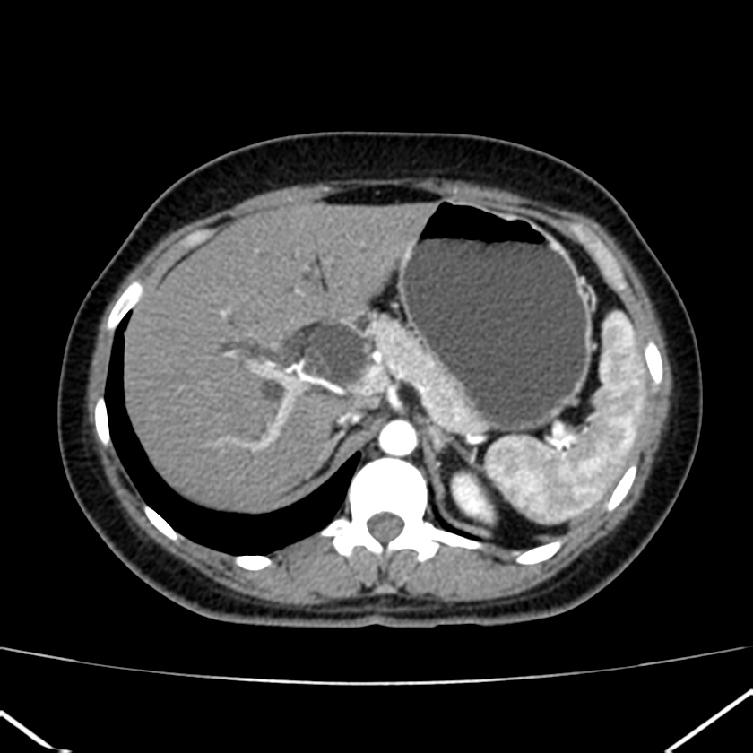 Ampullary tumor (Radiopaedia 22787-22816 B 24).jpg