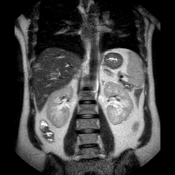 File:Ampullary tumor (Radiopaedia 27294-27479 Coronal T2 17).jpg