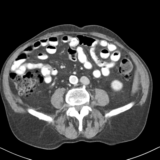 File:Amyand hernia (Radiopaedia 39300-41547 A 40).png