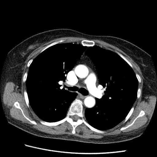 File:Amyloidosis - bronchial and diffuse nodular pulmonary involvement (Radiopaedia 60156-67745 A 21).jpg