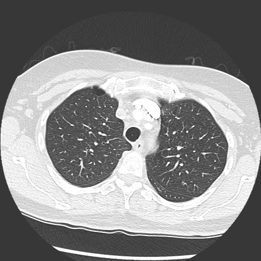 Amyloidosis - bronchial and diffuse nodular pulmonary involvement (Radiopaedia 60156-67745 Axial lung window 18).jpg