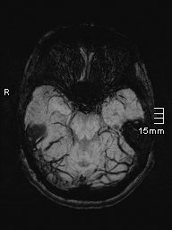 File:Amyotrophic lateral sclerosis (Radiopaedia 70821-81017 Axial SWI minIP 12).jpg