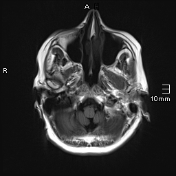 File:Amyotrophic lateral sclerosis (Radiopaedia 70821-81017 Axial T1 5).jpg
