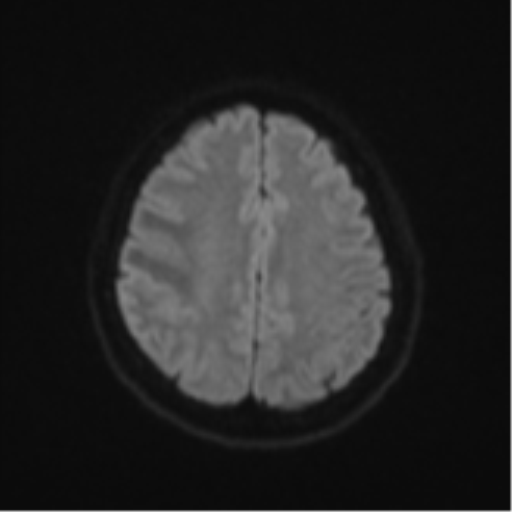 Anaplastic astroblastoma (Radiopaedia 55666-62194 Axial DWI 49).png