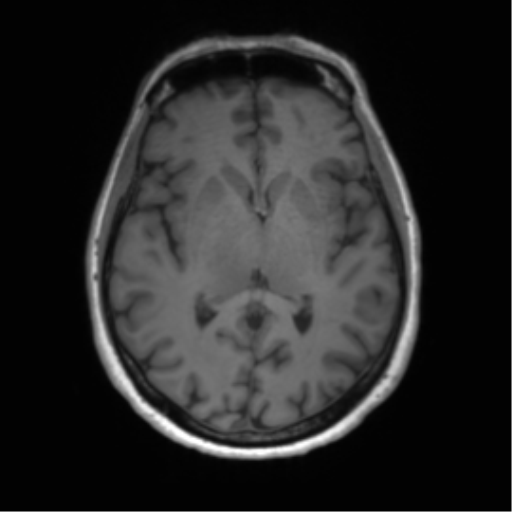 File:Anaplastic astrocytoma - thalamic glioma (Radiopaedia 59709-67115 Axial T1 15).png